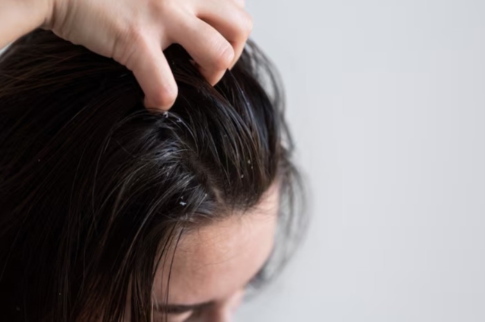 Jangan Sepelekan, Kenali 6 Tanda Kulit Kepala Butuh Istirahat dari Pewarnaan Rambut