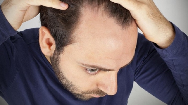 Kebotakan Pada Rambut Pria Dimulai dari Bagian Depan, Begini Alasannya!