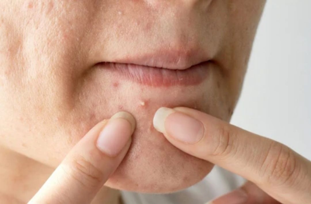 Tak Perlu Skincare Mahal, Coba Ramuan Pagi Ini untuk Atasi Jerawat Membandel dalam 7 Hari