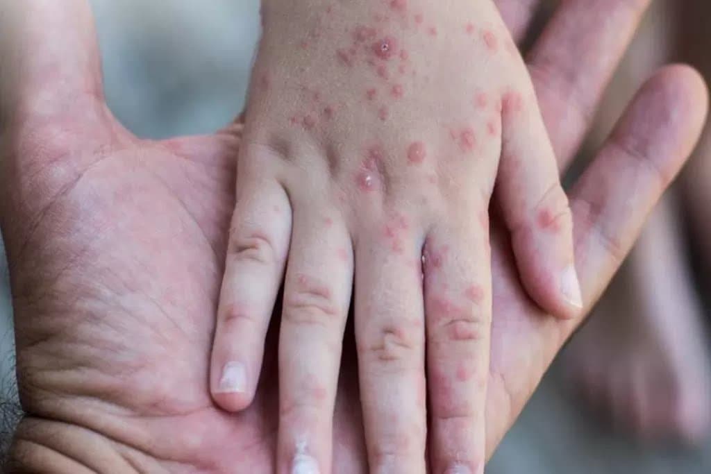 Gubernur Pramono Pastikan Jakarta Masih Nihil Kasus Campak, Meskipun Daerah Penyangga Sudah Terjangkit