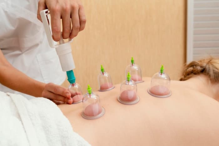 Termasuk Bisa Turunkan Tekanan Darah, Simak 5 Manfaat Bekam yang Jarang Diketahui Berikut Ini