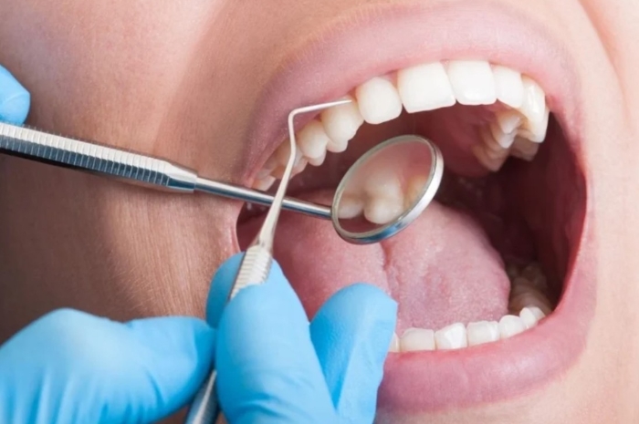 Gigi Bersih dan Sehat, Ini Pentingnya Scaling Setelah Lebaran