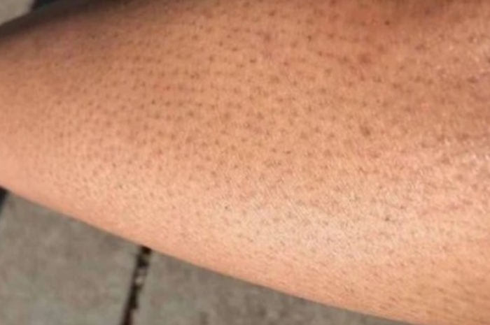 Empat Cara Mengatasi Strawberry Skin agar Kulit Lebih Halus