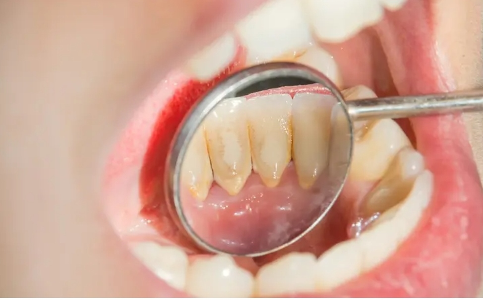 Awas! Gigi Bisa Goyang Tanpa Lubang, Ini Bahaya Rokok bagi Kesehatan Mulut