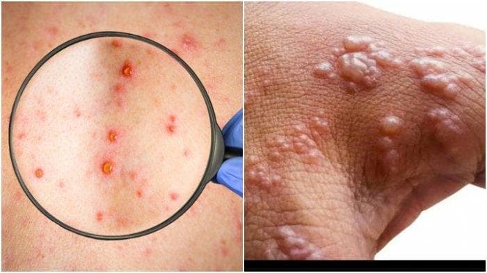 Kenali 5 Perbedaan Cacar Monyet, Cacar Air dan Campak, Agar Tak Salah Pengobatan