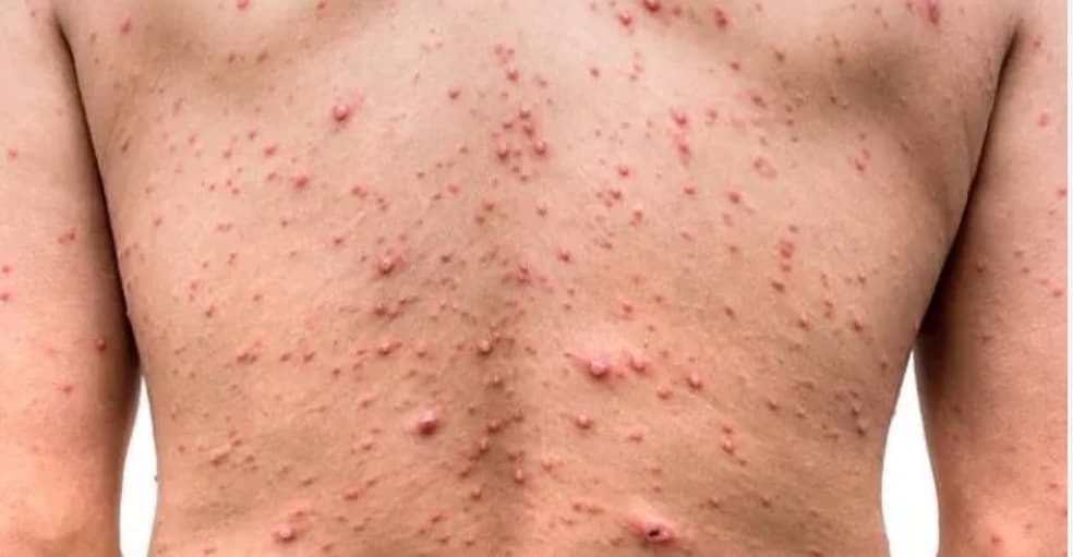 Apa Itu Penyakit Cacar Monyet atau Monkeypox, Apa Saja Ciri-cirinya? Berikut Penjelasannya.