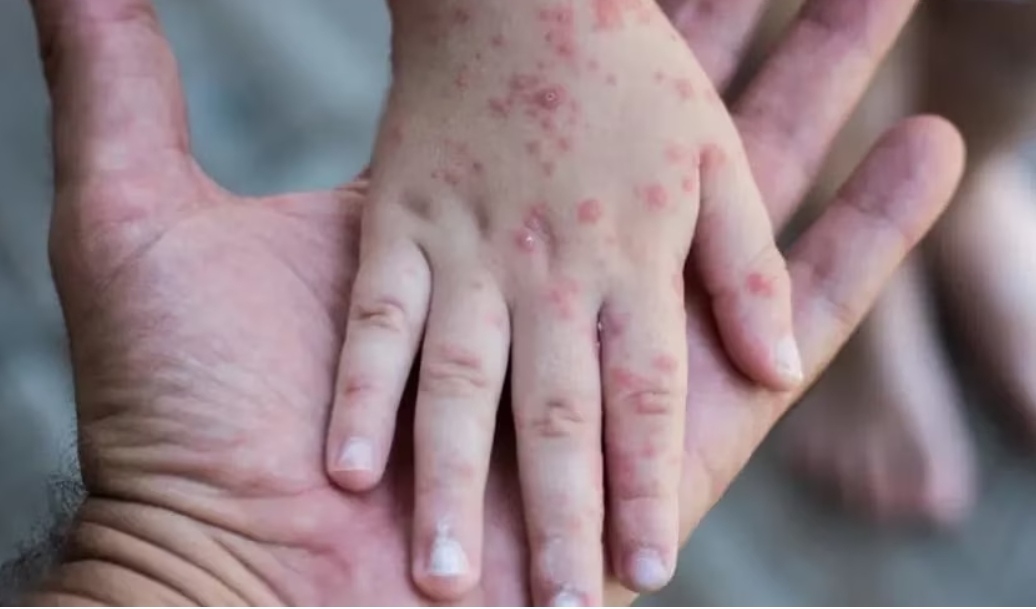 Monkeypox, Kenali Cara Penularan Penyakit yang Ditetapkan WHO Sebagai Darurat Kesehatan Global