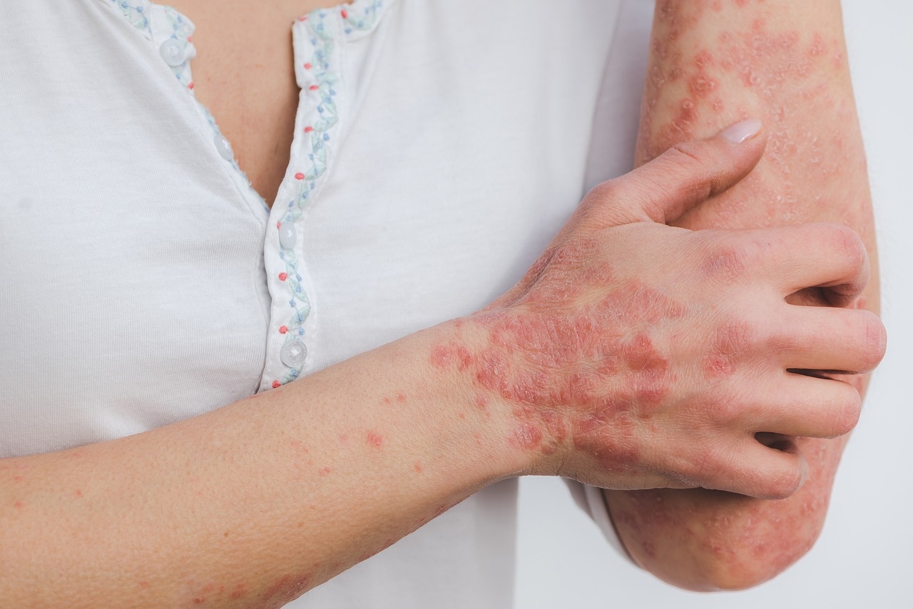 8 Langkah Pagi yang Mungkin Anda Lewatkan untuk Mengatasi Psoriasis: Hentikan Kebiasaan Merokok?