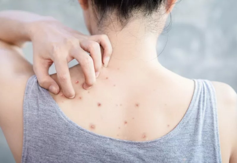 Tips Atasi Jerawat Punggung Secara Alami dan Medis, Nggak Ribet!