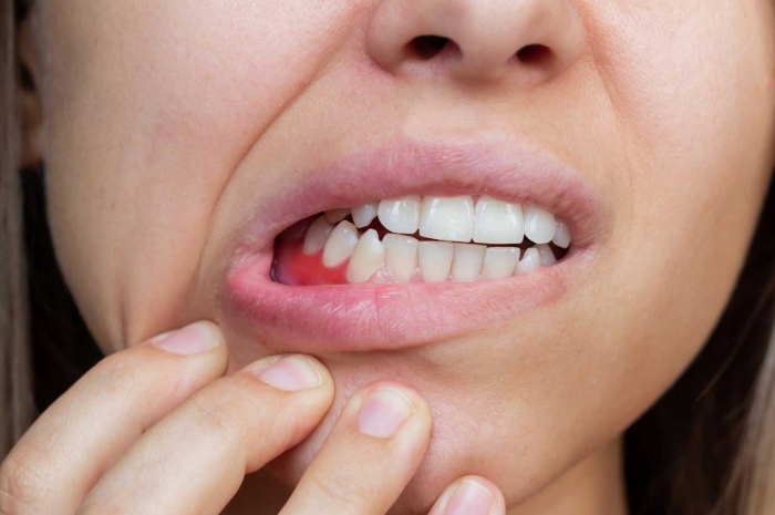 Jarang Disadari, Penyakit Gusi Ternyata Berisiko ke Seluruh Tubuh